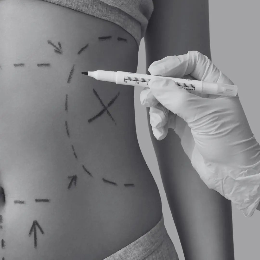 Lipo HD y Marcación Abdominal: La Evolución de la Cirugía Plástica Corporal en 2026